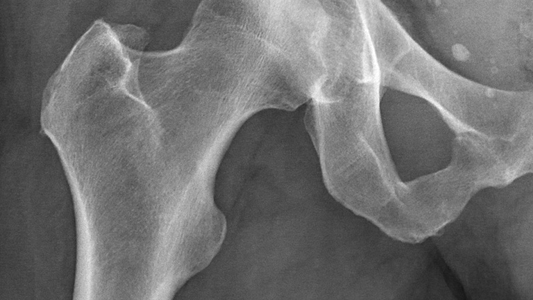 X-Ray of hip bone
